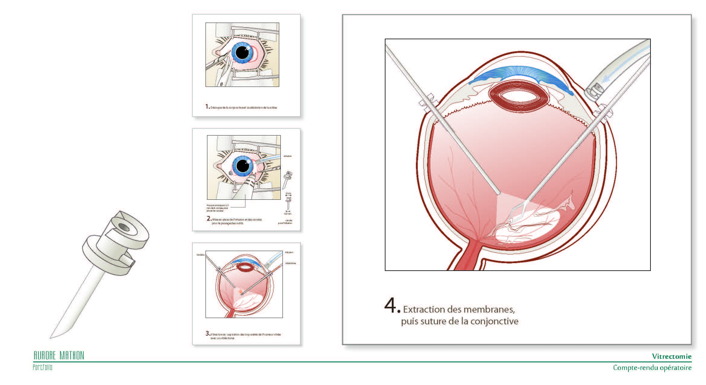 Vitrectomie - compte-rendu opratoire